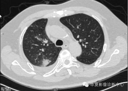 【病例学习】甲型H7N9禽流感一例