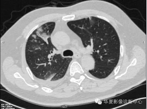【病例学习】甲型H7N9禽流感一例