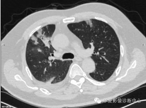 【病例学习】甲型H7N9禽流感一例