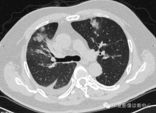 【病例学习】甲型H7N9禽流感一例