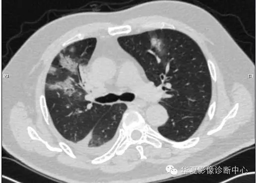 【病例学习】甲型H7N9禽流感一例