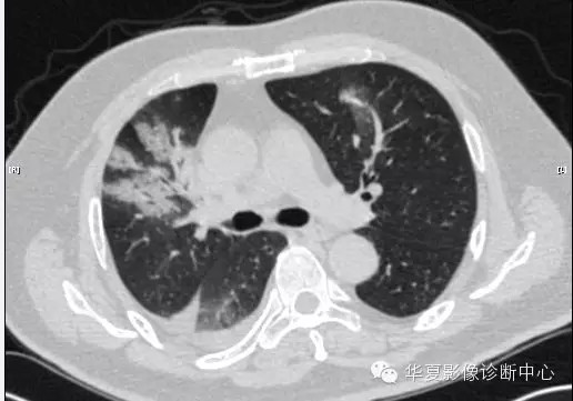 【病例学习】甲型H7N9禽流感一例