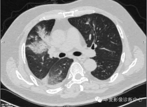 【病例学习】甲型H7N9禽流感一例