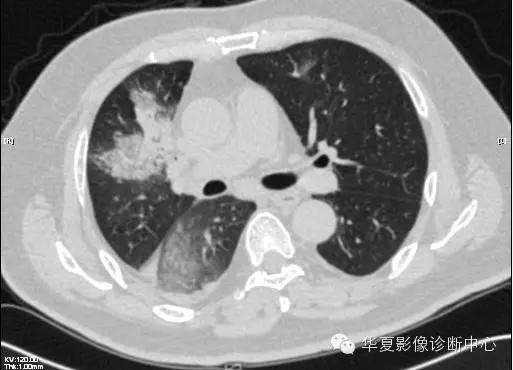 【病例学习】甲型H7N9禽流感一例