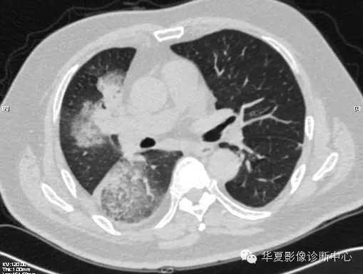 【病例学习】甲型H7N9禽流感一例