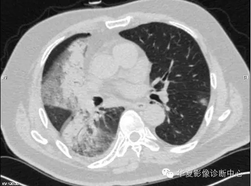【病例学习】甲型H7N9禽流感一例