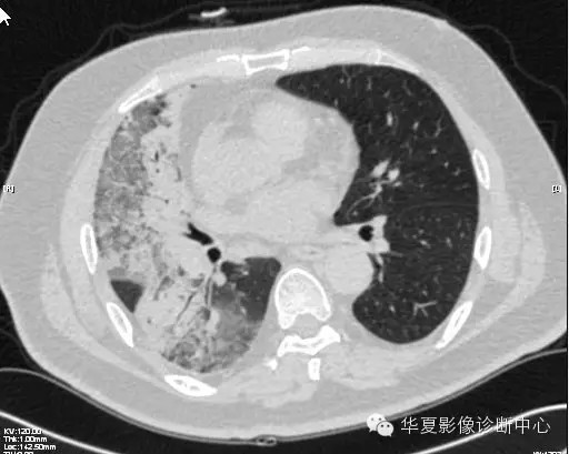 【病例学习】甲型H7N9禽流感一例