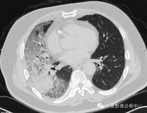 【病例学习】甲型H7N9禽流感一例