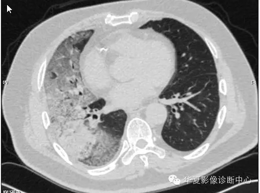 【病例学习】甲型H7N9禽流感一例