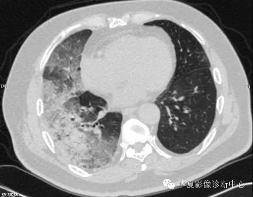 【病例学习】甲型H7N9禽流感一例