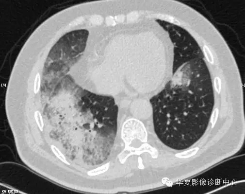 【病例学习】甲型H7N9禽流感一例