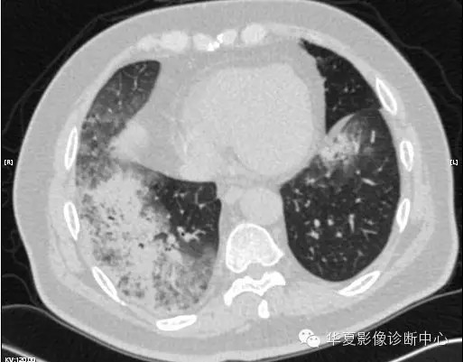 【病例学习】甲型H7N9禽流感一例