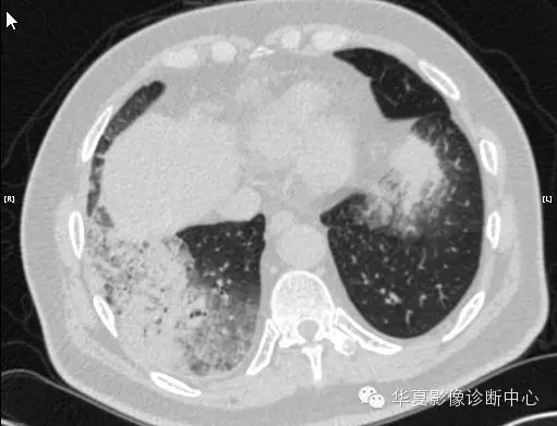【病例学习】甲型H7N9禽流感一例