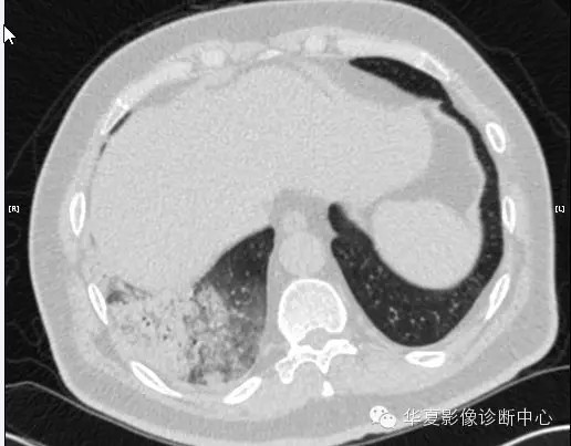 【病例学习】甲型H7N9禽流感一例
