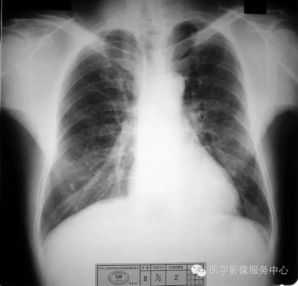 各期尘肺标准片及解读