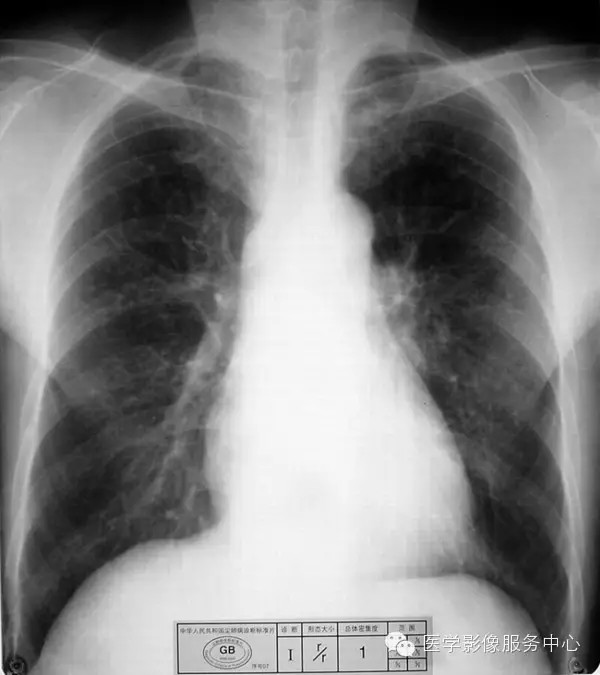 各期尘肺标准片及解读