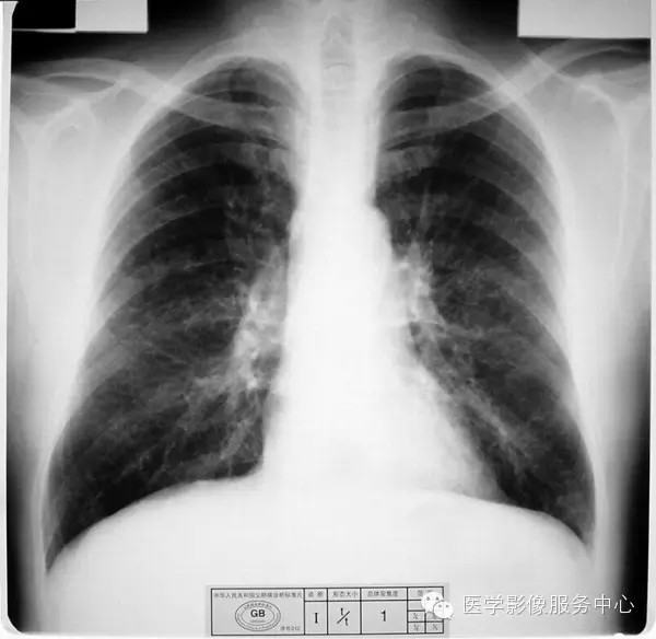 各期尘肺标准片及解读