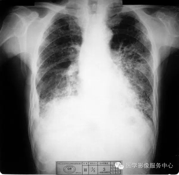 各期尘肺标准片及解读