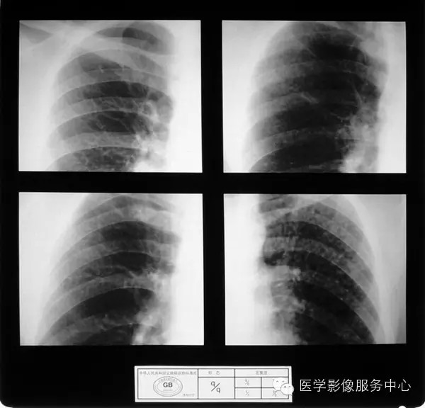 各期尘肺标准片及解读