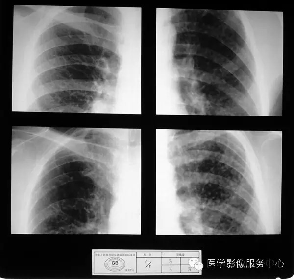 各期尘肺标准片及解读