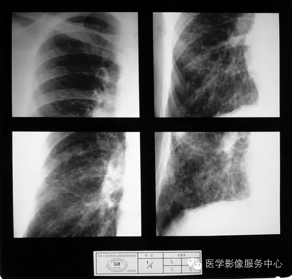各期尘肺标准片及解读