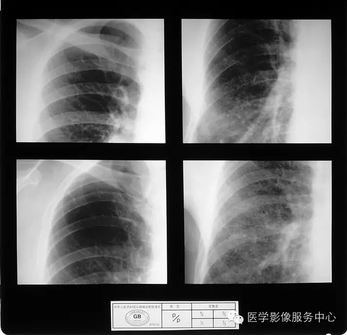 各期尘肺标准片及解读