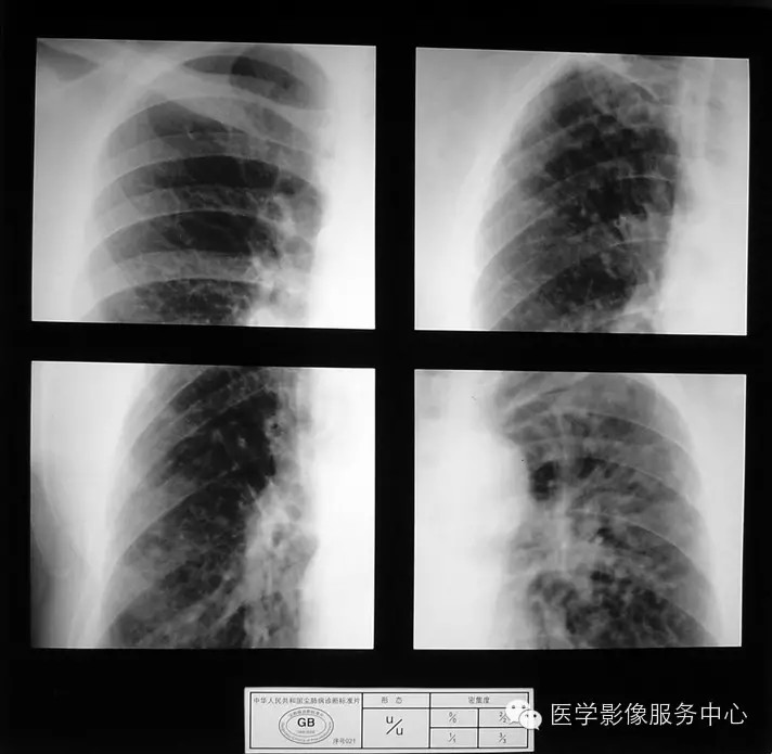各期尘肺标准片及解读