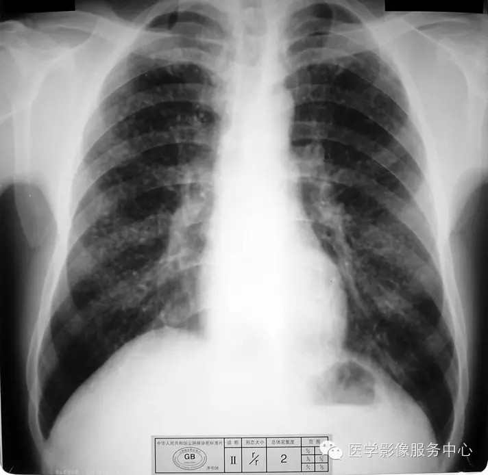 各期尘肺标准片及解读