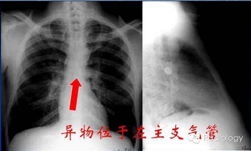 如何在X线片上鉴别异物硬币在气管或是食管内？