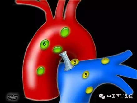 胸内（纵膈）淋巴结分区