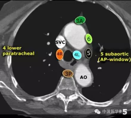 胸内（纵膈）淋巴结分区