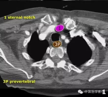 胸内（纵膈）淋巴结分区