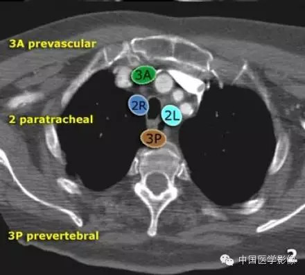 胸内（纵膈）淋巴结分区