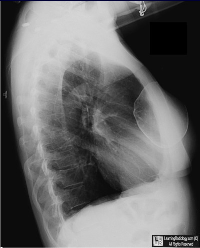 【病例学习】乳腺假体钙化一例