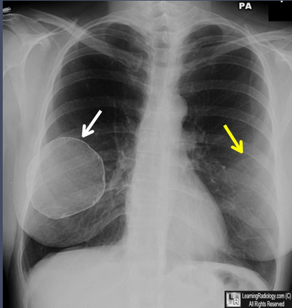 【病例学习】乳腺假体钙化一例