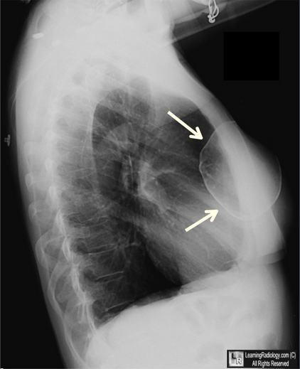 【病例学习】乳腺假体钙化一例