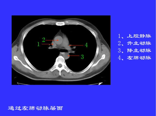 胸部CT阅读与诊断
