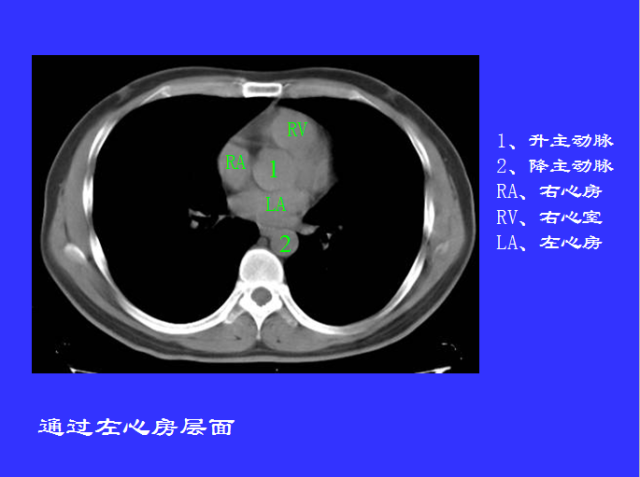 胸部CT阅读与诊断