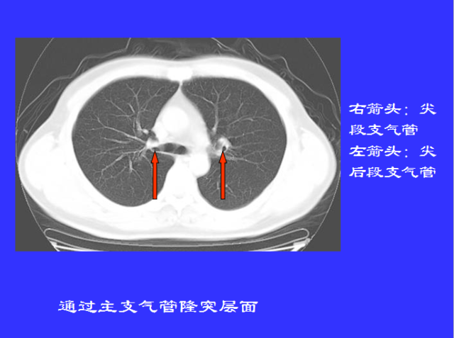 胸部CT阅读与诊断