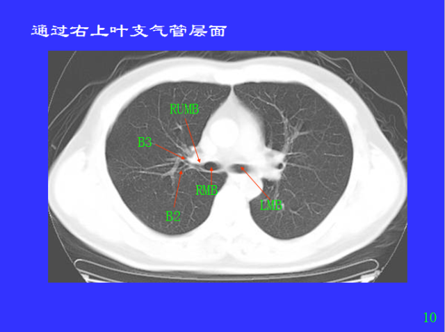 胸部CT阅读与诊断