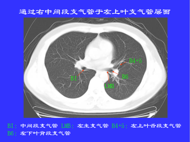 胸部CT阅读与诊断