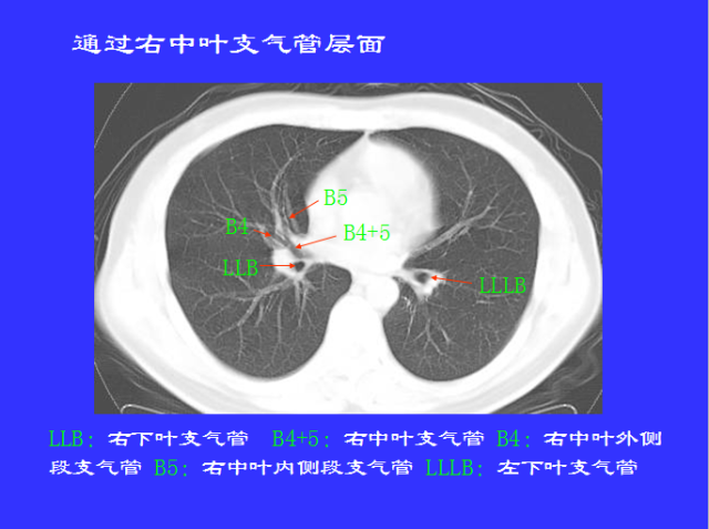 胸部CT阅读与诊断