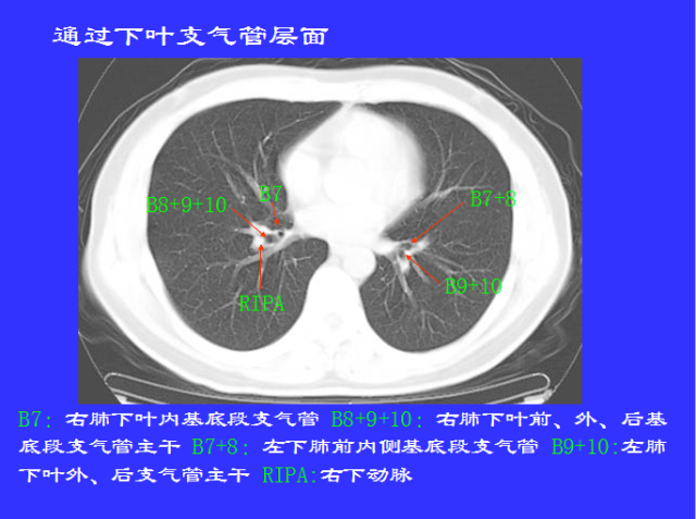 胸部CT阅读与诊断