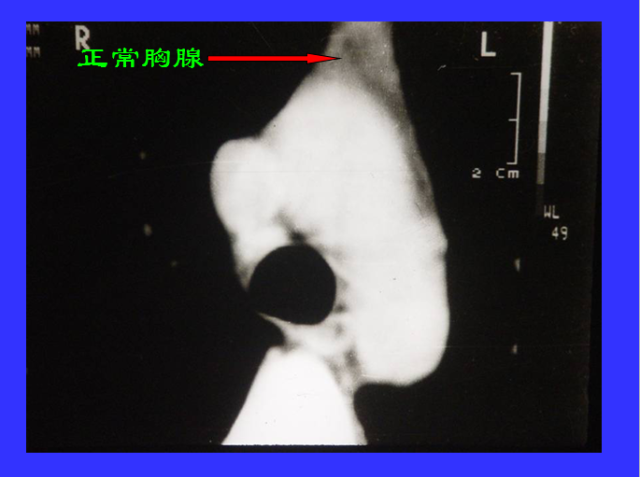 胸部CT阅读与诊断