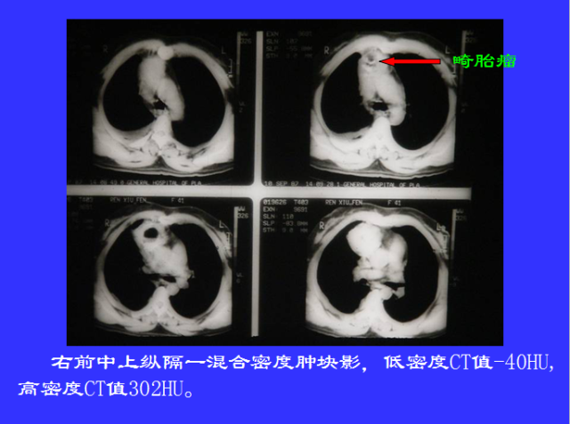 胸部CT阅读与诊断