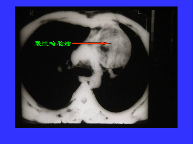 胸部CT阅读与诊断