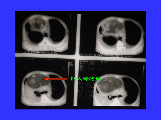 胸部CT阅读与诊断