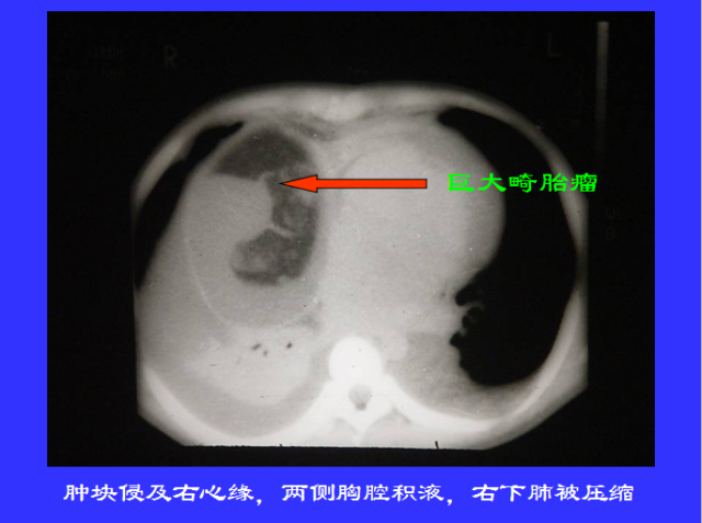 胸部CT阅读与诊断