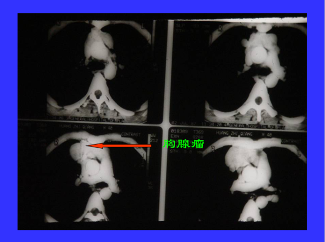 胸部CT阅读与诊断