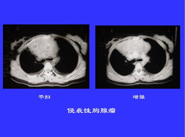 胸部CT阅读与诊断